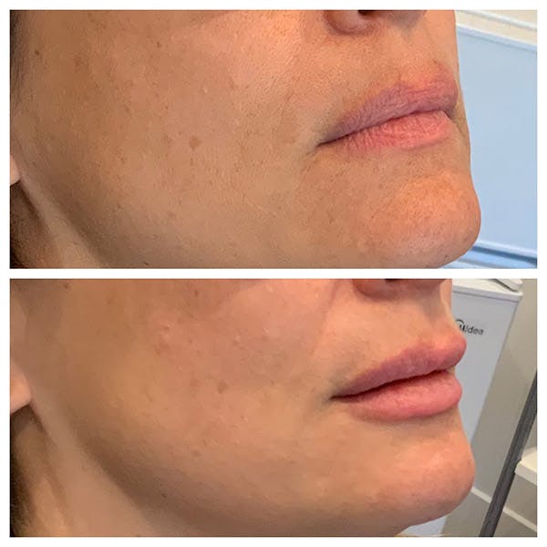 Lips Before & After Gallery - Patient 27018901 - Image 3