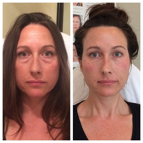 Liquid Facelift Before & After Gallery - Patient 27018902 - Image 1