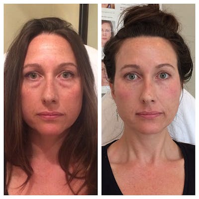 Liquid Facelift Before & After Gallery - Patient 27018902 - Image 1