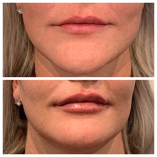 Lips Before & After Gallery - Patient 27018903 - Image 1