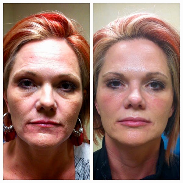 Liquid Facelift Before & After Gallery - Patient 27018904 - Image 1