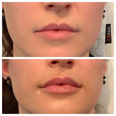 Lips Before & After Gallery - Patient 27018905 - Image 1