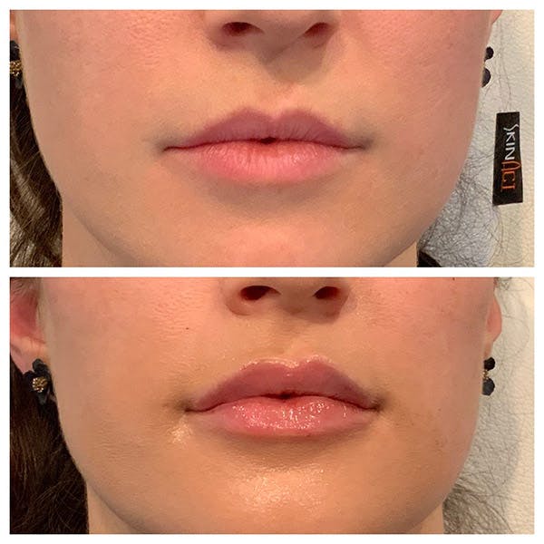 Lips Before & After Gallery - Patient 27018905 - Image 1