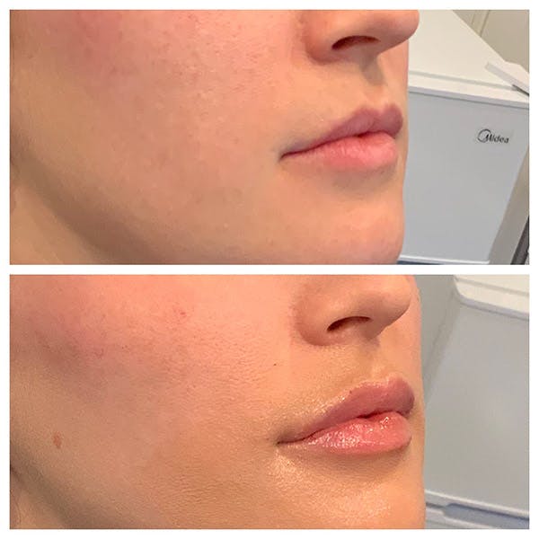 Lips Before & After Gallery - Patient 27018905 - Image 2