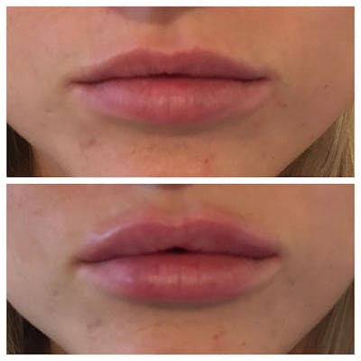 Lips Before & After Gallery - Patient 27018906 - Image 1