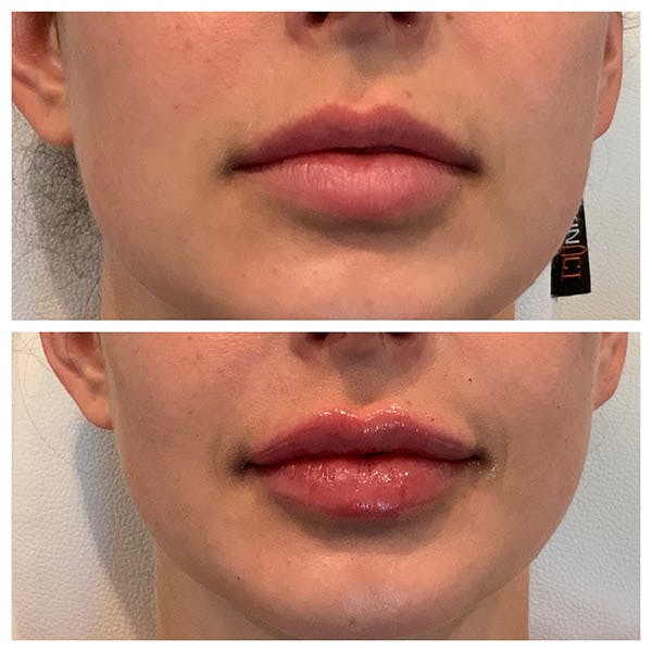 Lips Before & After Gallery - Patient 27018910 - Image 1