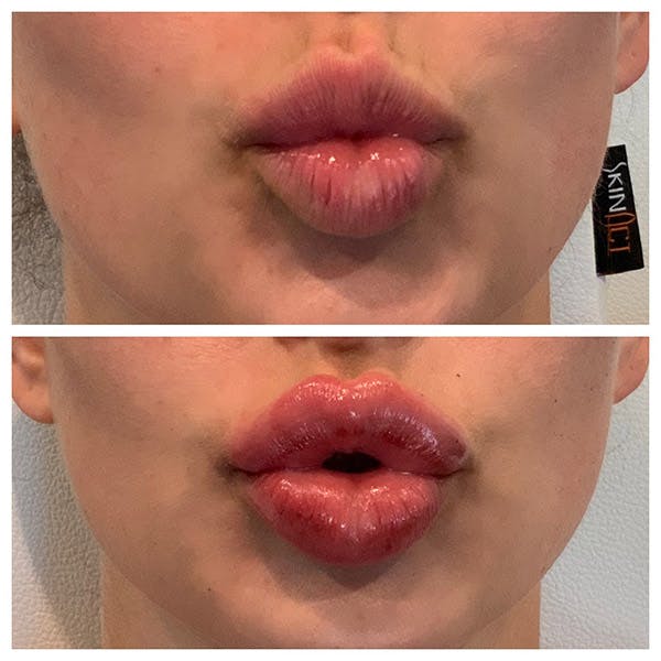 Lips Before & After Gallery - Patient 27018910 - Image 3