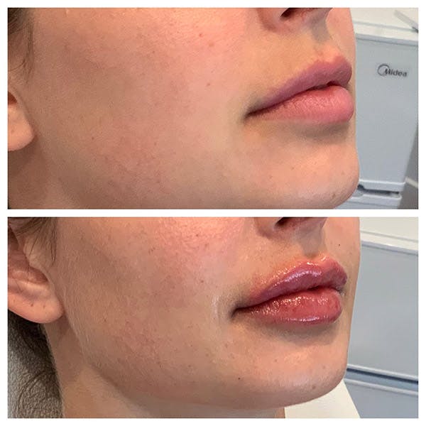 Lips Before & After Gallery - Patient 27018910 - Image 4