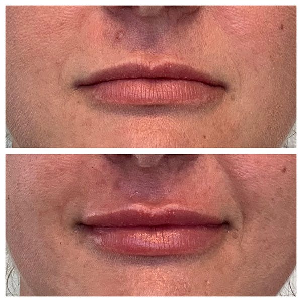 Lips Before & After Gallery - Patient 27018911 - Image 1