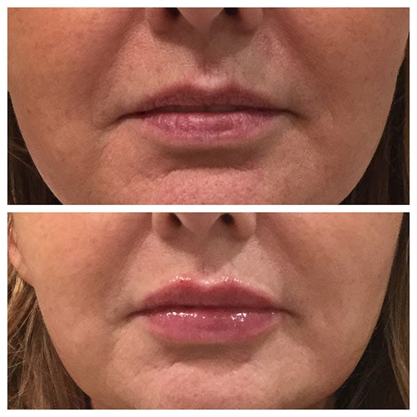 Lips Before & After Gallery - Patient 27018912 - Image 1