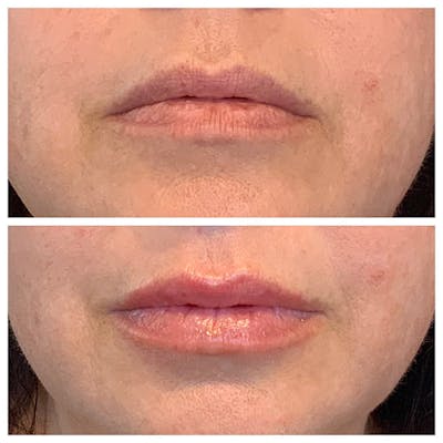 Lips Before & After Gallery - Patient 27018915 - Image 1