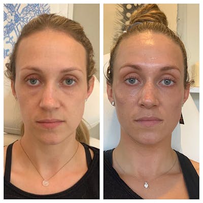 Mid-face Volume Before & After Gallery - Patient 27018916 - Image 1