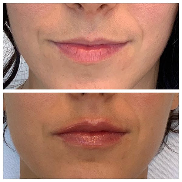Lips Before & After Gallery - Patient 27018917 - Image 1