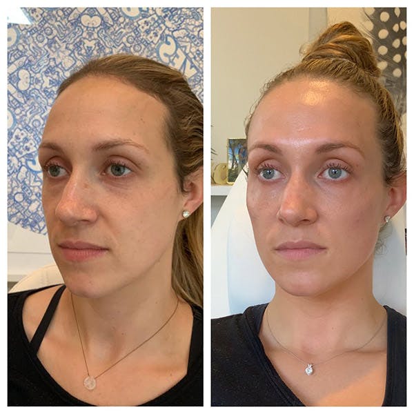 Mid-face Volume Before & After Gallery - Patient 27018916 - Image 2
