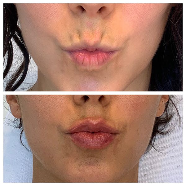 Lips Before & After Gallery - Patient 27018917 - Image 2