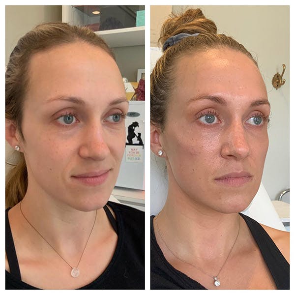 Mid-face Volume Before & After Gallery - Patient 27018916 - Image 3