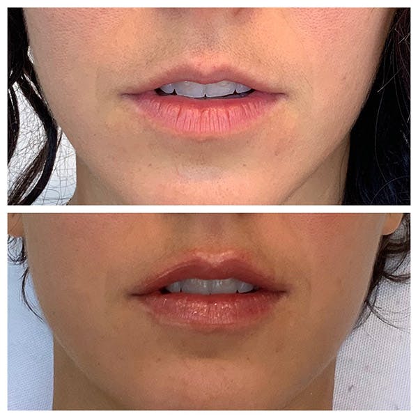 Lips Before & After Gallery - Patient 27018917 - Image 3