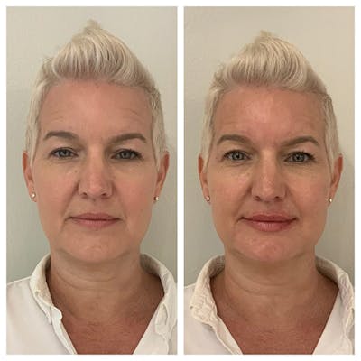 Mid-face Volume Before & After Gallery - Patient 27018919 - Image 1