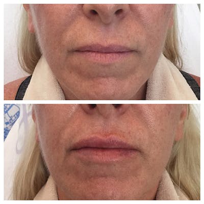 Lips Before & After Gallery - Patient 27018918 - Image 1