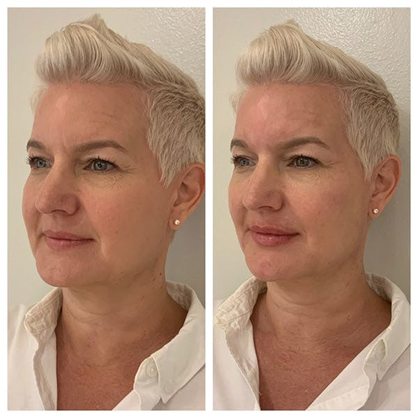 Facial Rejuvenation  Before & After Gallery - Patient 27018919 - Image 2
