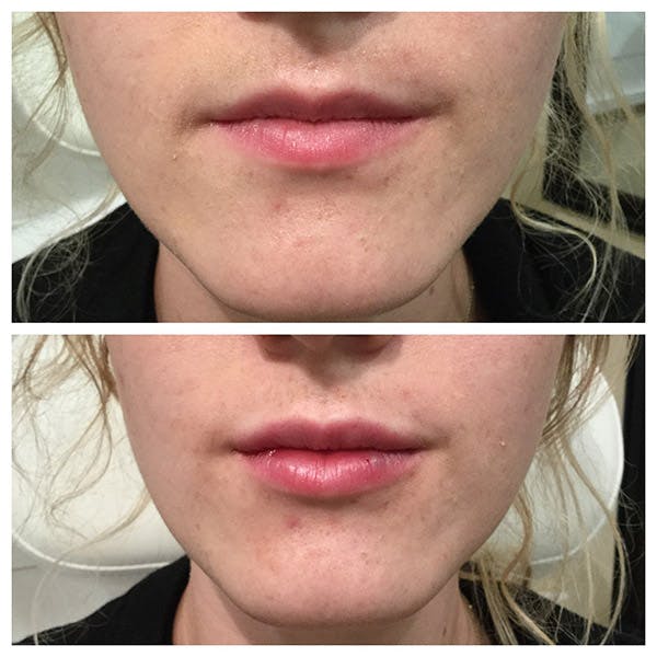 Lips Before & After Gallery - Patient 27018920 - Image 1