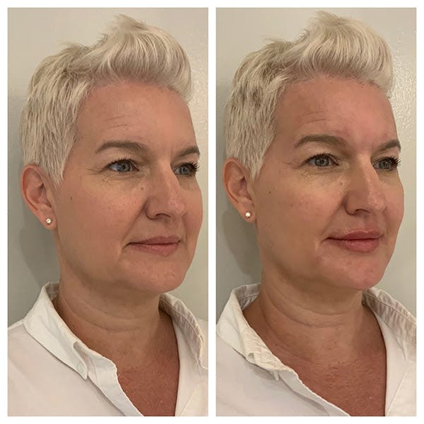 Mid-face Volume Before & After Gallery - Patient 27018919 - Image 3