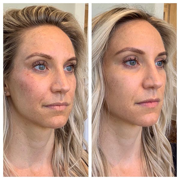 Facial Rejuvenation  Before & After Gallery - Patient 27018921 - Image 1