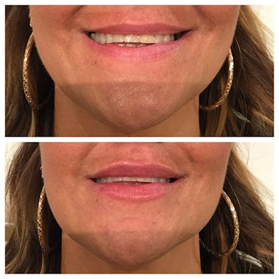 Lips Before & After Gallery - Patient 27018927 - Image 1