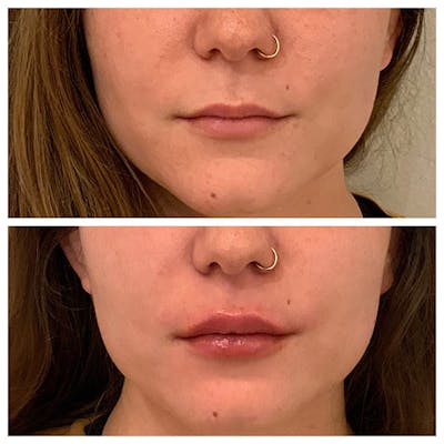 Lips Before & After Gallery - Patient 27018929 - Image 1
