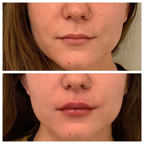 Lips Before & After Gallery - Patient 27018929 - Image 1