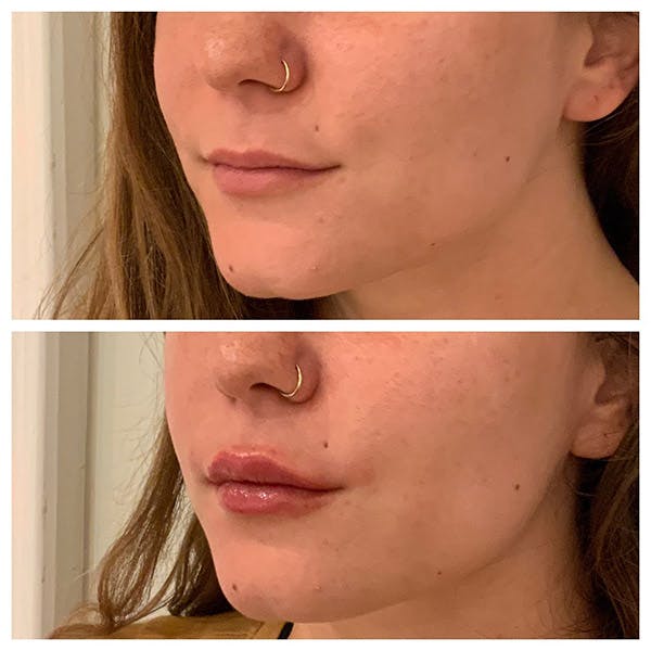Lips Before & After Gallery - Patient 27018929 - Image 3