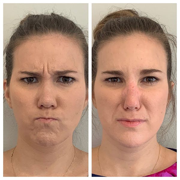Neuromodulators Before & After Gallery - Patient 27018930 - Image 2