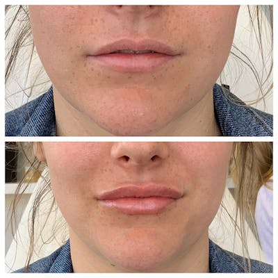 Lips Before & After Gallery - Patient 27018931 - Image 1