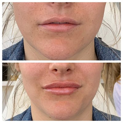 Lips Before & After Gallery - Patient 27018931 - Image 1