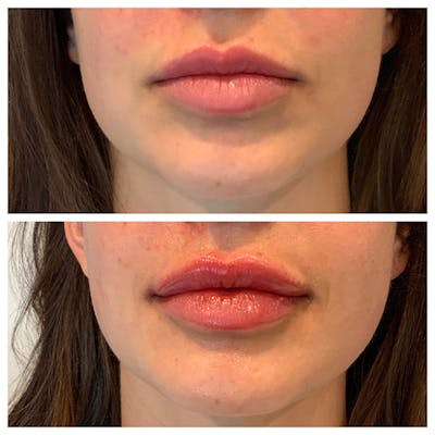 Lips Before & After Gallery - Patient 27018934 - Image 1