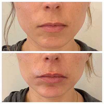 Lips Before & After Gallery - Patient 27018937 - Image 1