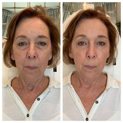 Tear Troughs Before & After Gallery - Patient 27018942 - Image 1