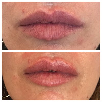 Lips Before & After Gallery - Patient 27018941 - Image 1