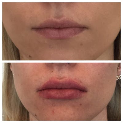 Lips Before & After Gallery - Patient 27018943 - Image 1