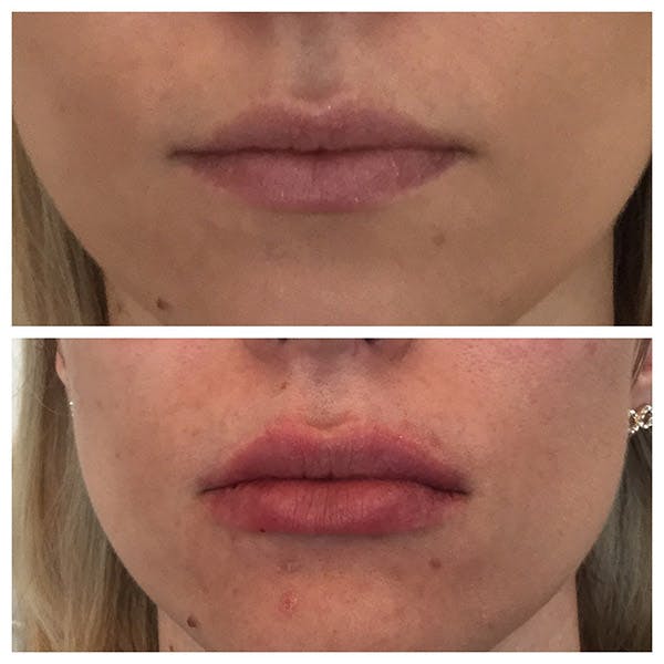 Lips Before & After Gallery - Patient 27018943 - Image 1