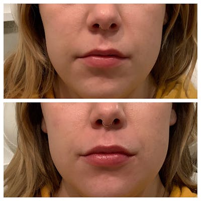 Lips Before & After Gallery - Patient 27018946 - Image 1