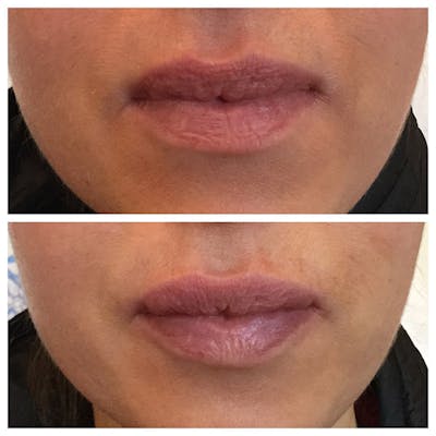 Lips Before & After Gallery - Patient 27018948 - Image 1