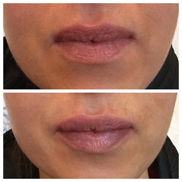 Lips Before & After Gallery - Patient 27018948 - Image 1