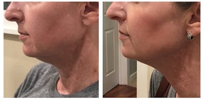 Kybella Before & After Gallery - Patient 27018951 - Image 1