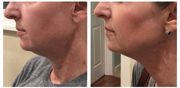 Kybella Before & After Gallery - Patient 27018951 - Image 1