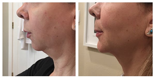 Kybella Before & After Gallery - Patient 27018953 - Image 1