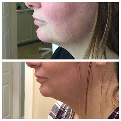 Kybella Before & After Gallery - Patient 27018954 - Image 1