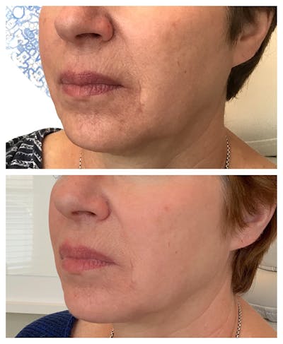 Kybella Before & After Gallery - Patient 27018956 - Image 1