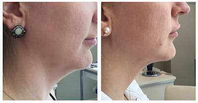 Kybella Before & After Gallery - Patient 27018960 - Image 1