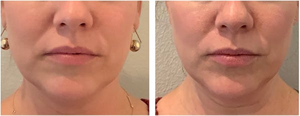 Kybella Before & After Gallery - Patient 27018961 - Image 1
